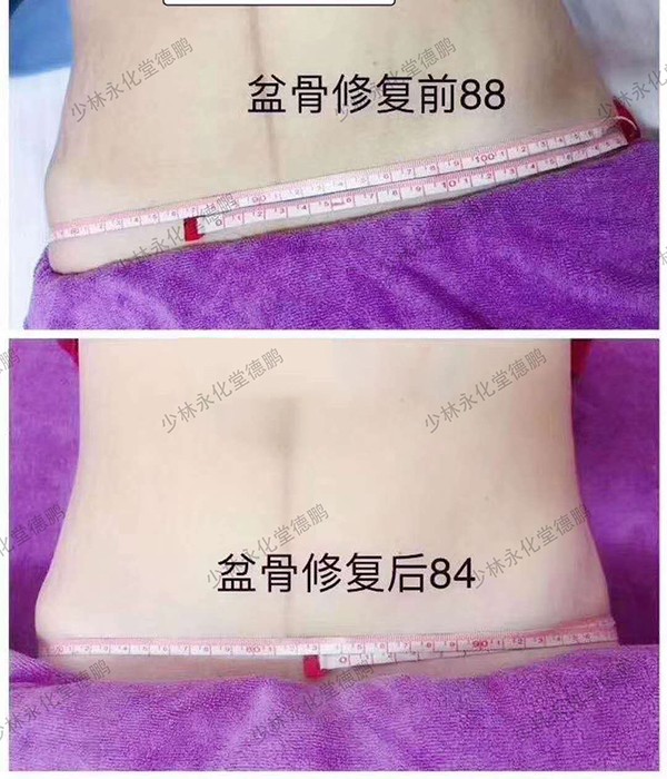 少林永化堂產(chǎn)后項(xiàng)目-骨盆修復(fù)